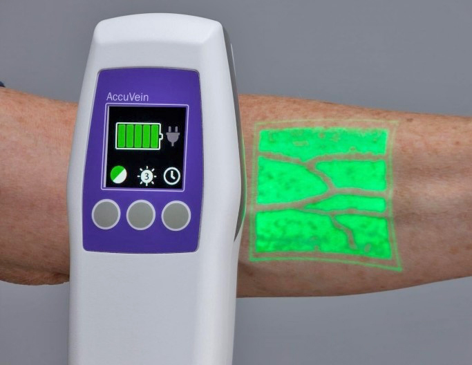 The AccuVein shows exactly where a patient’s veins are. (Contributed photo)